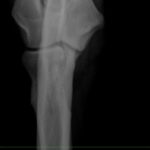 X-ray of Pasha's left elbow made in 2018. Front view.