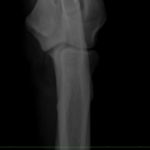 X-ray of Pasha's right elbow made in 2018. Front view.